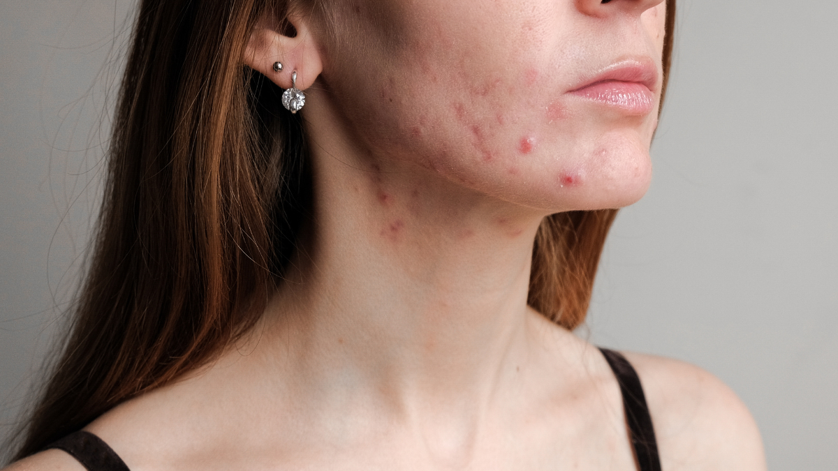 Layered acne treatment plans